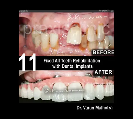 Complete full mouth reconstruction with implants and ceramic crowns before and after — full mouth rehabilitation Mumbai India PRAXIS Dental Dr Varun Malhotra